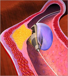 Rotablator Procedure