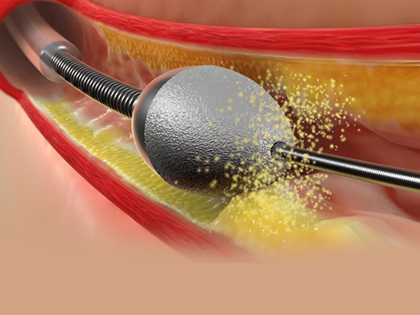 Rotablation Angioplasty